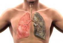 Καρκίνος πνευμόνων: Δείτε τα συμπτώματα που πρέπει να γνωρίζετε